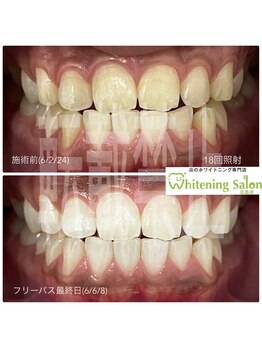 ホワイトニングサロン 広島店/【ホワイトニング18回照射】