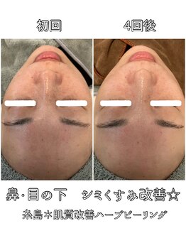 エヌプラス(N+)/40代女性*ピーリング4回後