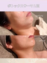 エン 橿原店(en)/VTXサーマ直後の驚きの変化！