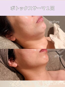 エン 橿原店(en)/VTXサーマ直後の驚きの変化！