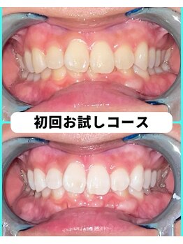 ホワイトニングビューティー 吉祥寺店/ホワイトニング 初来店