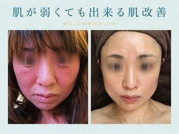 ウー 上熊本(WOO)の写真/２週間限定【人気no.1】肌が弱くても出来る次世代針ハーブピーリング　12,000円→7,700円