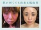 ウー 上熊本(WOO)の写真/２週間限定【人気no.1】肌が弱くても出来る次世代針ハーブピーリング　12,000円→7,700円