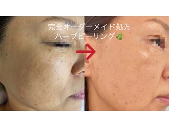 チョンダムビューティー(chondam beauty)/ハーブピーリングの効果実感2