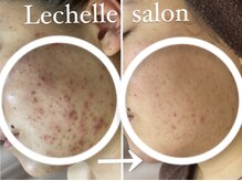 レシェルサロン(Lechelle Salon)の雰囲気（剥離有ハーブピーリングもお施術可能です！）