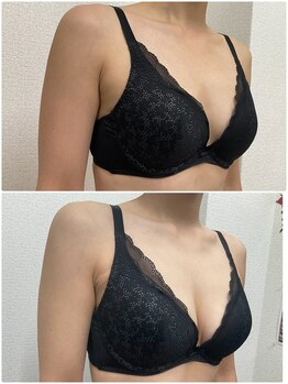 バーディー(BIRDIE)/施術3回/４０代ママ