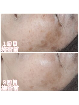 ピュルテ/肌トレ、艶活コース