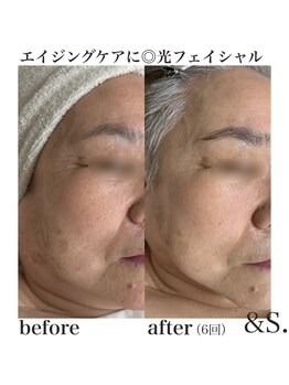 アンドエス(&S.)/人気メニュー☆光フェイシャル