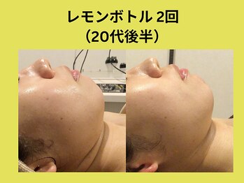 リンク 錦糸町店(Link)/レモンボトル2回