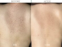 気になる背中のブツブツやザラザラもハーブピーリングでケア♪