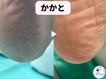 プラスワンフット 本厚木(+1 Foot)/ガサガサかかとを、つるつるに♪