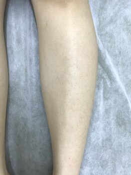 ナノハナ/鹿沼市の全身脱毛のナノハナ