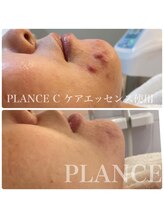 プランス 熊本店(PLANCE)/cケアエッセンス使用後