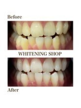ホワイトニングショップ 新宿店/【ホワイトニング】BeforeAfter
