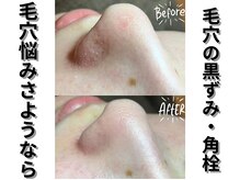 ティエル 高崎店(Tiele)の雰囲気（毛穴洗浄ケア☆黒ずみや白いプツプツ角栓もスッキリ）