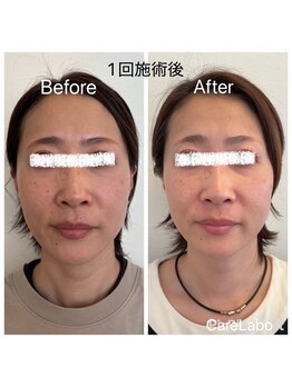 ケアラボ(Care Labo)/【FN美容鍼】