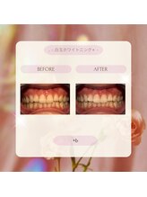 プラスビー 2号店(+b)/ホワイトニングビフォーアフター