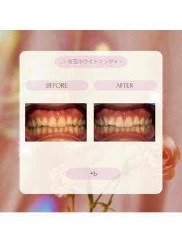 プラスビー 2号店(+b)/ホワイトニングビフォーアフター
