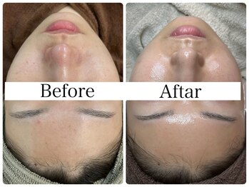 リラビューティー(Lilas Beauty)/荒れやすいお肌からの美肌改善!