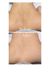 エラン(ELAN)/【Dr,s背中ハーブピーリング】