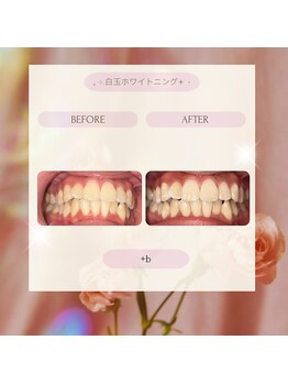 プラスビー 2号店(+b)/ホワイトニングビフォーアフター