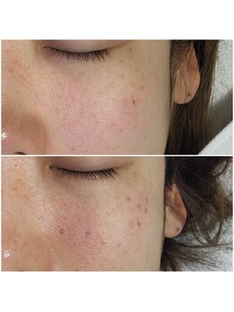 コタカ(KOTAKA)/＜シミケア＞