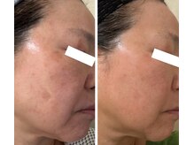 30年前のしつこいシミも6ヶ月でこの通り