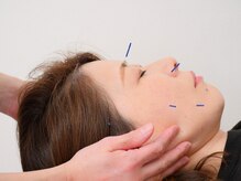 小顔美容鍼灸　　クマ、たるみ、リフトアップに
