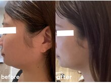 レアビューティー(Le'a beauty)/小顔たるみメニュー