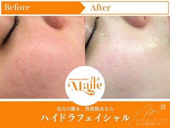 まいれ鍼灸院整骨院 整体院 草津院/ハイドラ／20代女性／施術6回