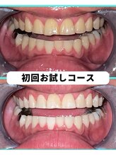 ホワイトニングビューティー 吉祥寺店/ホワイトニング　初来店