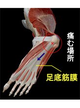 メディカルケア カイロ 南与野/足底筋膜炎