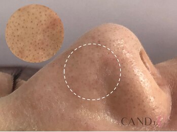 キャンディ 大阪梅田店(CANDi)/ハイドラピーリング/黒ずみ毛穴