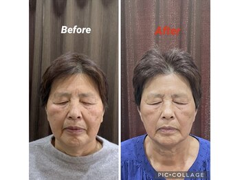 鍼灸チャンドラ(鍼灸Chandra)/女優鍼