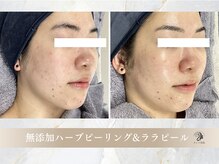 キレイ美肌 北心斎橋店/無添加ハーブピーリング