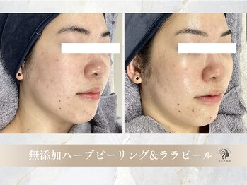 キレイ美肌 北心斎橋店/無添加ハーブピーリング