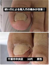 巻き爪じゅん 千葉駅前店/硬い爪による陥入爪の痛みが改善