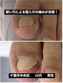 硬い爪による陥入爪の痛みが改善