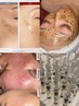 【圧倒的効果★肌老化悩みが尽きない方】ハーブ療法×LDMSKIN×アンプル導入