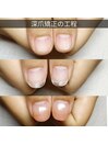【深爪矯正】ちゅるん爪改造計画