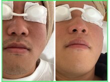 クリア 尾張旭店(Clear)/【Clear脱毛ビフォーアフター】