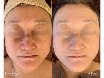 インナーメス(INNER MES)/磁石の力で瞬間美白