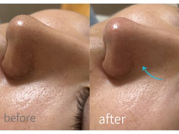 ルーム701(room701)/毛穴洗浄 毛穴黒ずみ除去