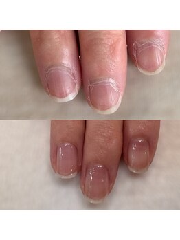 ニマ(nima)/自爪育成　自爪矯正