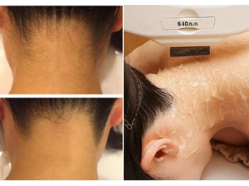 リーインカーナ アーティスト(REINCARNA ARTIST)の写真/今から始めても夏に間に合う！全身360度まるごと脱毛で、毛穴レス美白コラーゲンケアしませんか？