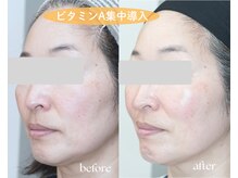 岩川治療院/ビタミンA集中導入　短期肌改善
