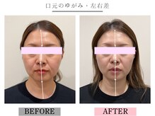 グレースエール トータルビューティーサロン(Grace Aile)/口元のゆがみ・左右差