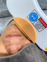 ブラックスワン(Black Swan)/ヒゲ脱毛