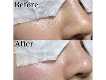 ベア(Bea)/《毛穴改善コース》3回の変化