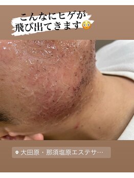 アムール(Amour)/メンズヒゲ脱毛お試し1,100円